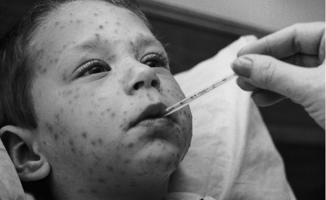 Rising cases of chicken pox in Kanpur