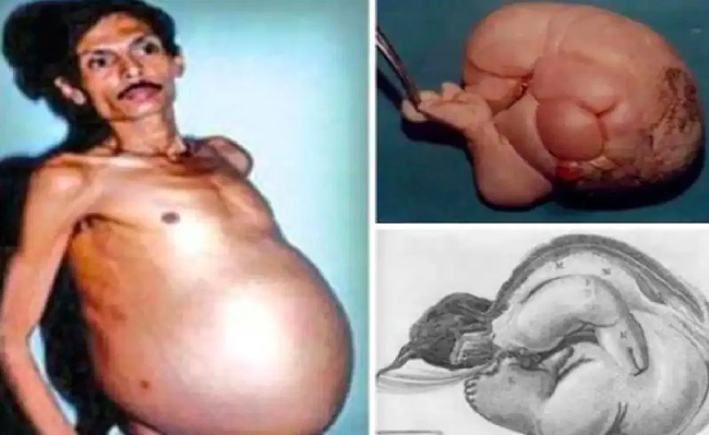 Nagpur man pregnant with his dead twin