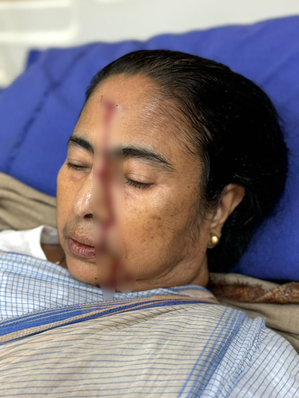 बंगाल  की सीएम ममता बनर्जी को सिर पर लगी गंभीर चोट, एसएसकेएम अस्पताल में भर्ती