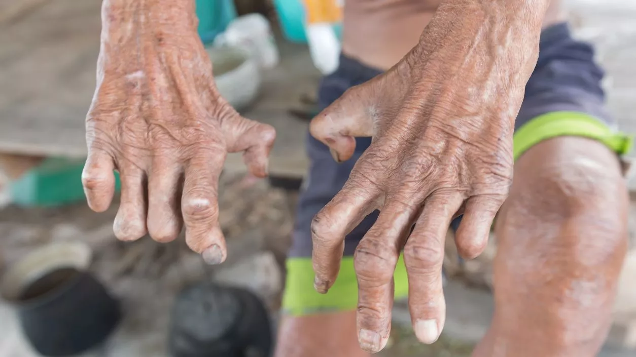India accounts for 53% of global leprosy cases, targets eradication by 2027: Reports