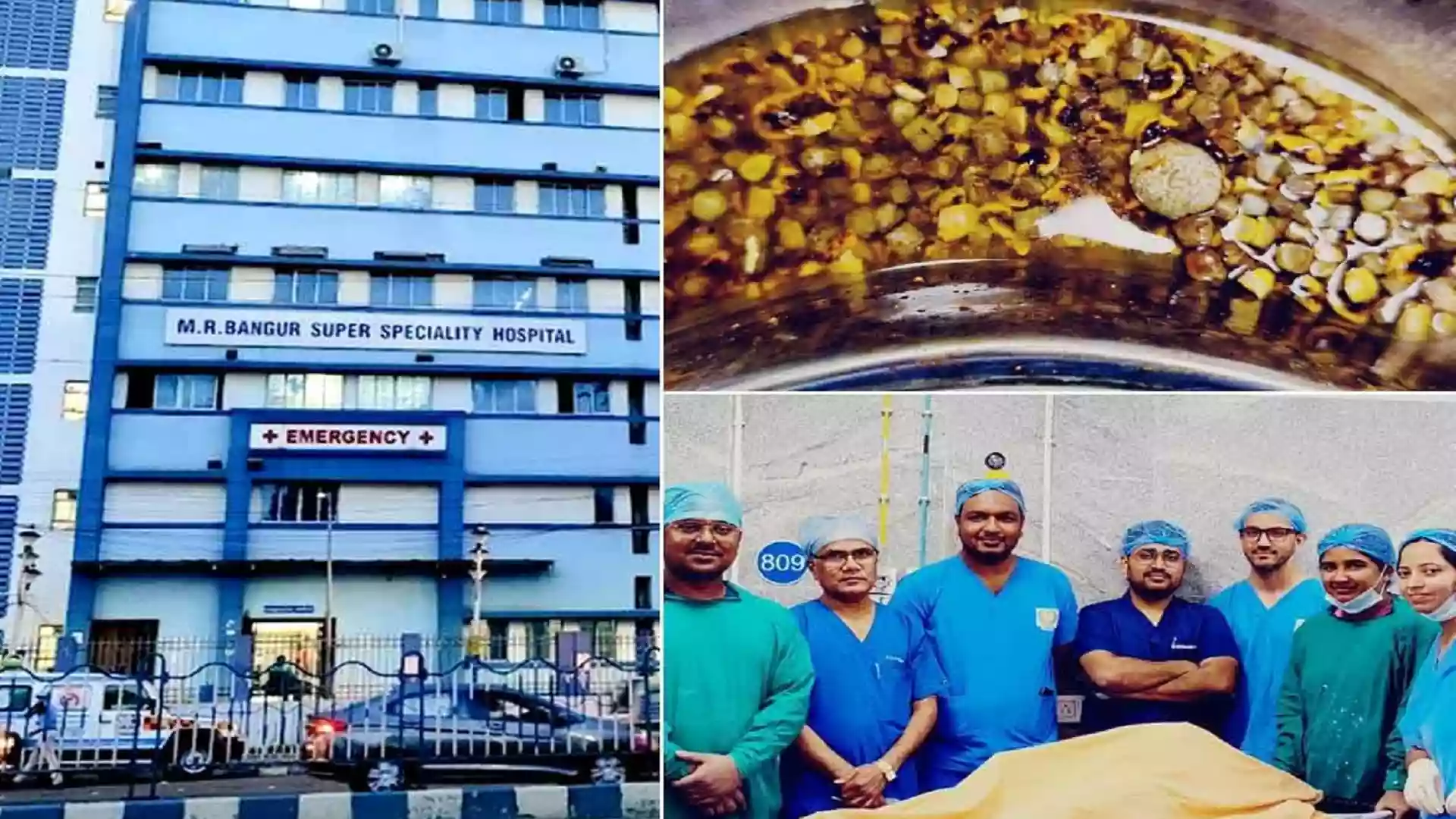 Surgeons at MR Bangur hospital remove nearly 2,000 gallstones from a 75-year-old woman